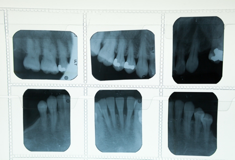 Dental x ray film for dental care concept
